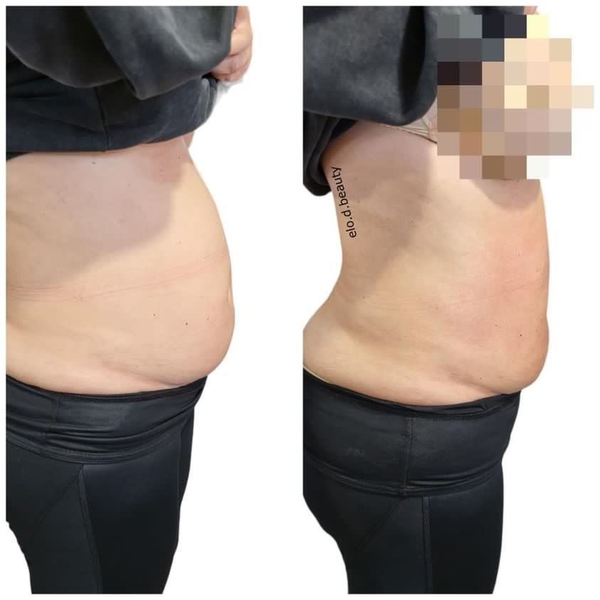 elodbeauty_soinMinceur Soin minceur avant / après