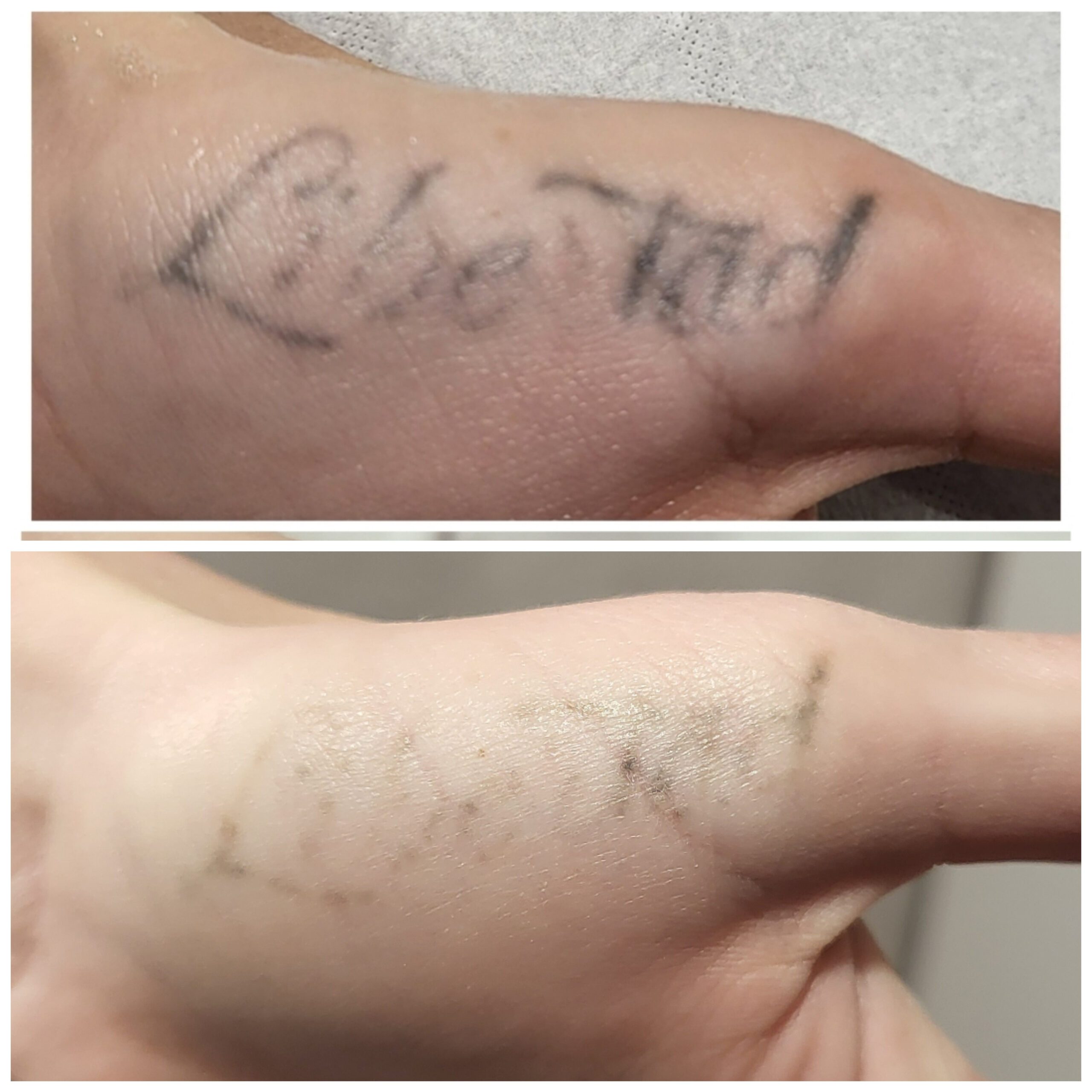 elodbeauty-21 Détatouage avant /après